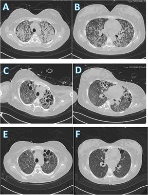 Successful Application of Argatroban During VV-ECMO in a Pregnant Patient Complicated With ARDS due to Severe Tuberculosis: A Case Report and Literature Review